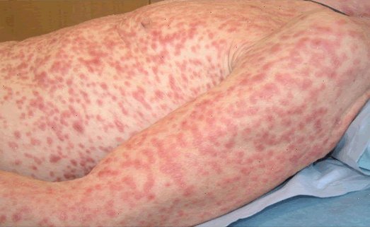 Sífilis: O que é? Formas de Contágio, Como Prevenir e Tipos de Tratamento