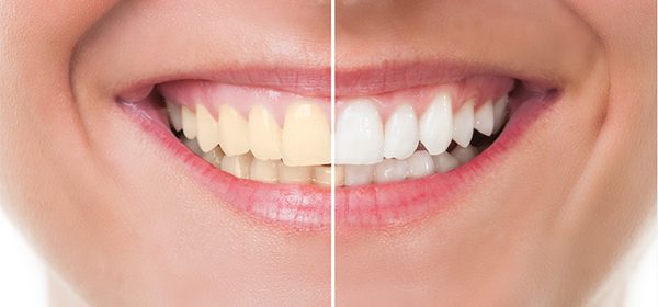clareamento dental