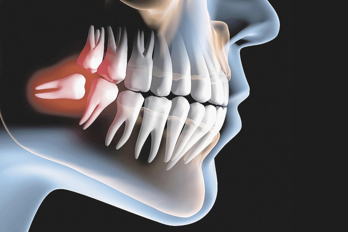 Quanto tempo leva para o dente siso nascer completamente? 