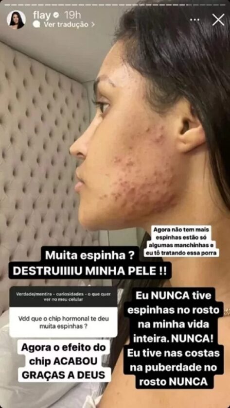 rosto cheio de acne de flay por causa de chip da beleza